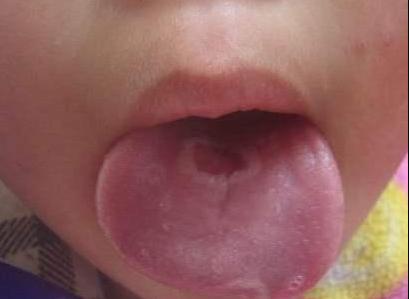 地图舌（浅表性、非感染性的舌部炎症）