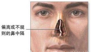 鼻中隔弯曲（疾病症状）