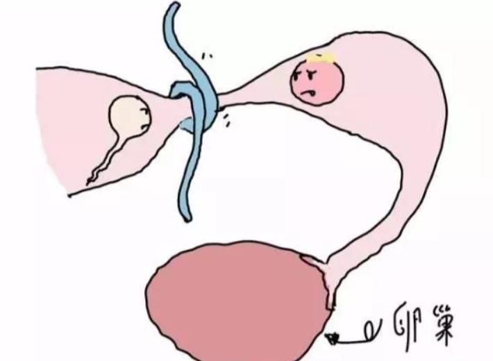 输卵管疏通术（妇科手术）