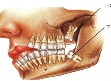 急性冠周炎（牙冠周围软组织发生的急性炎性反应）